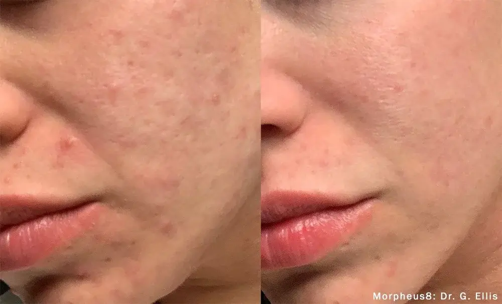Before and after acne