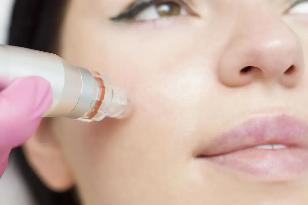 Microneedling woman