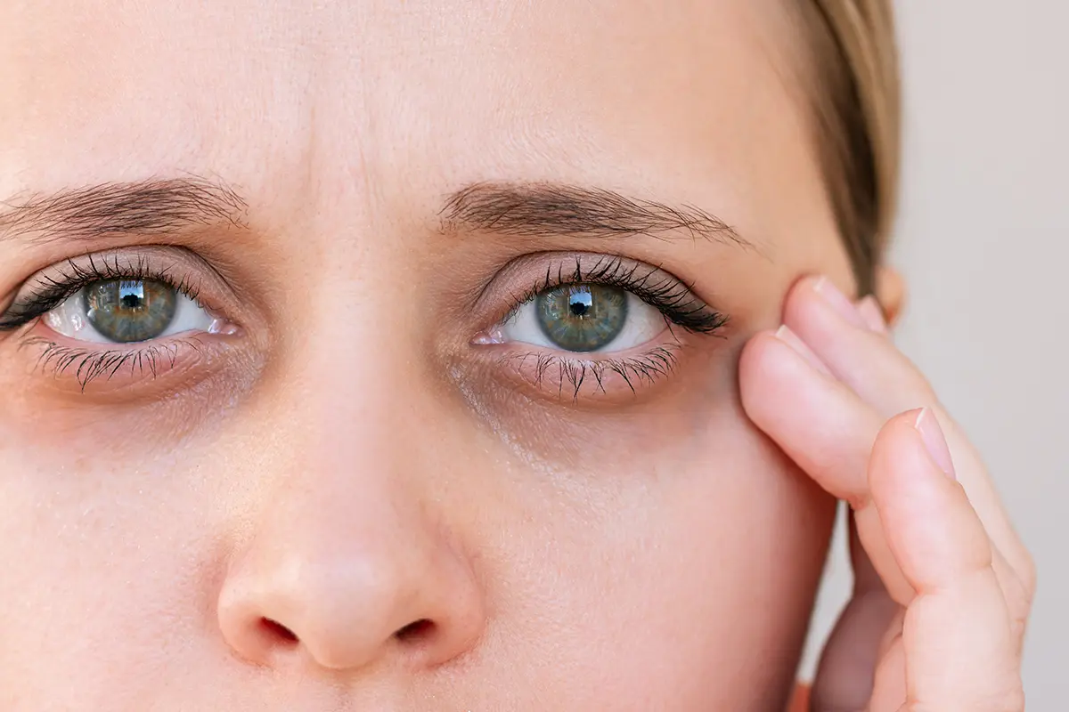Young woman with dark circles her eyes light background